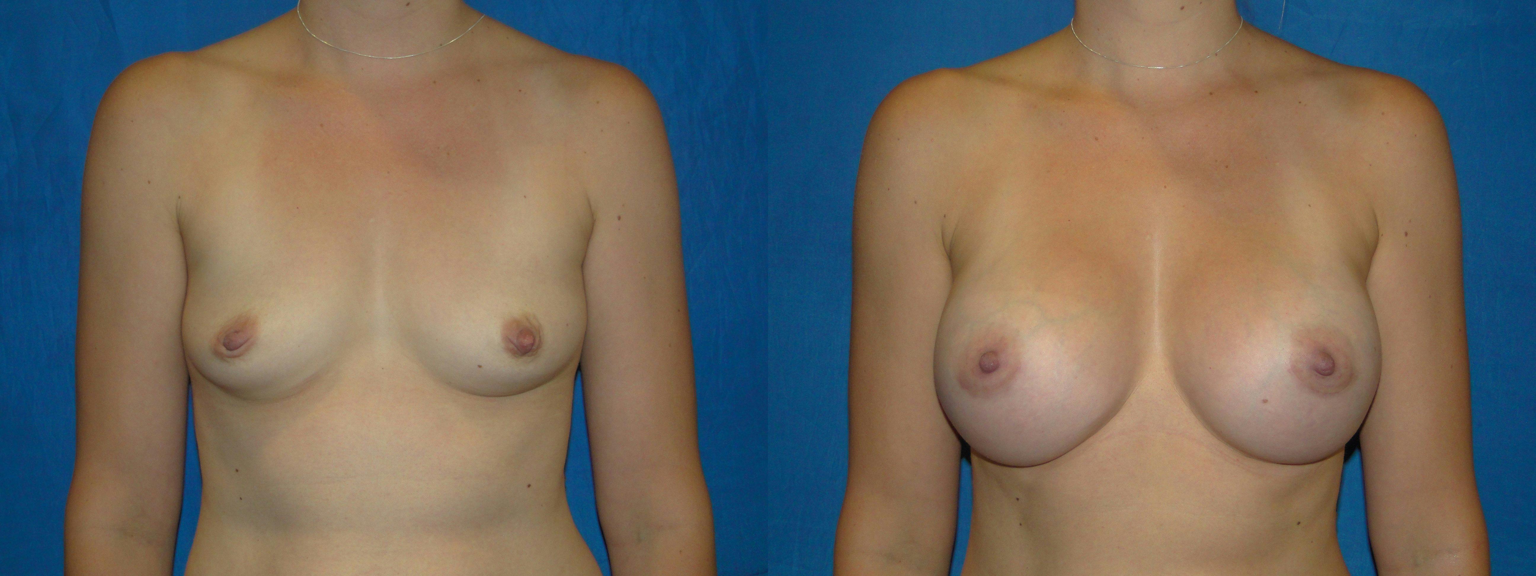 Before And After Breast Augmentation in Orange County - 06
