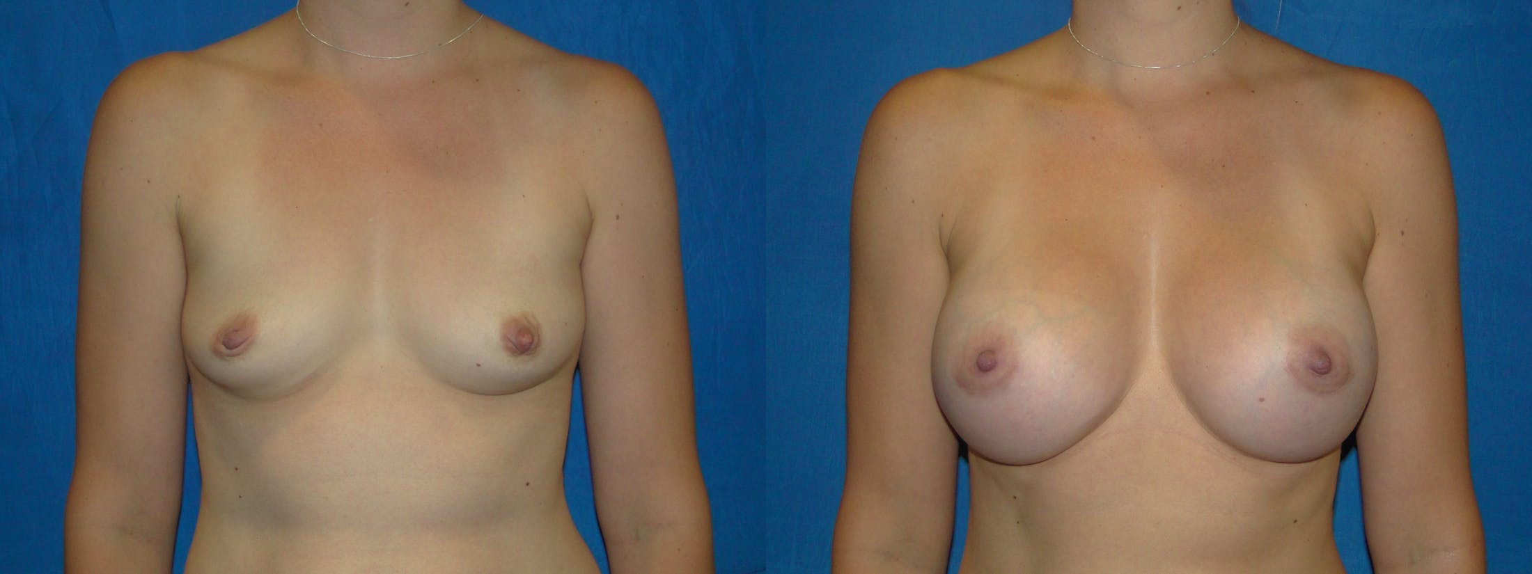 Breast Augmentation Before & After Gallery - Patient 74801796 - Image 1