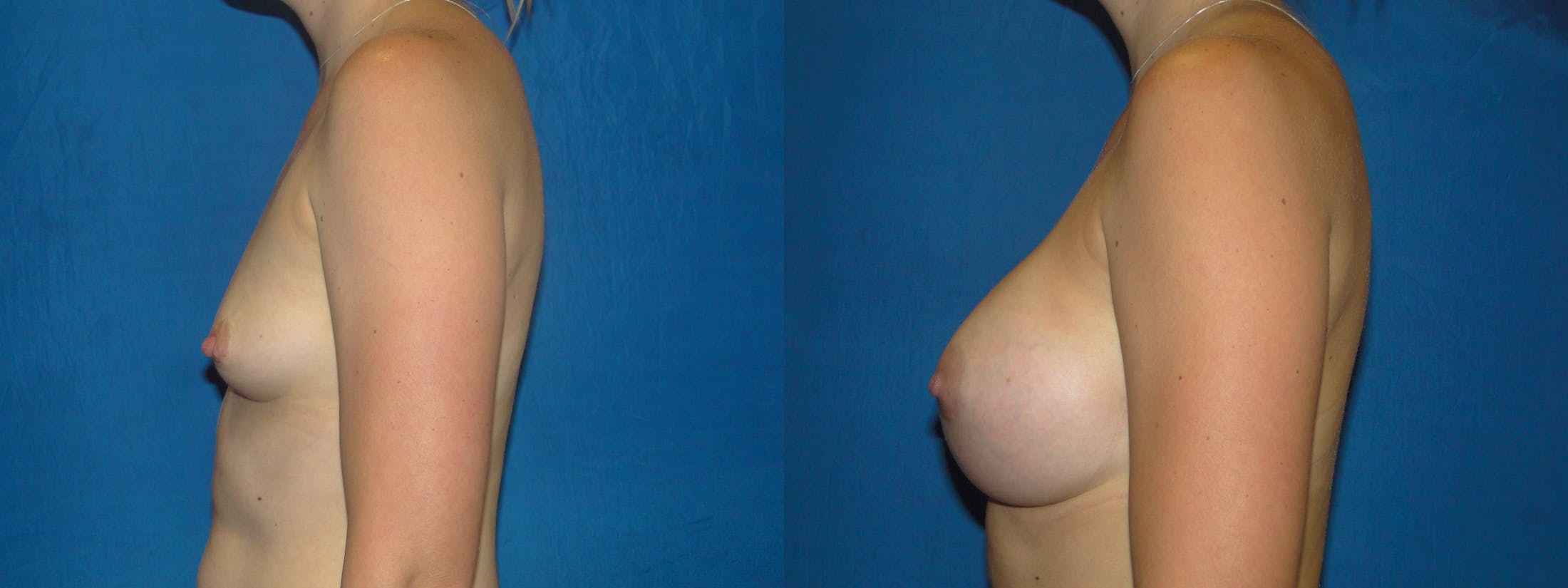 Breast Augmentation Before & After Gallery - Patient 74801796 - Image 2
