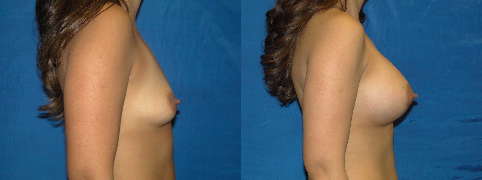 Breast Augmentation Before & After Gallery - Patient 74801797 - Image 2