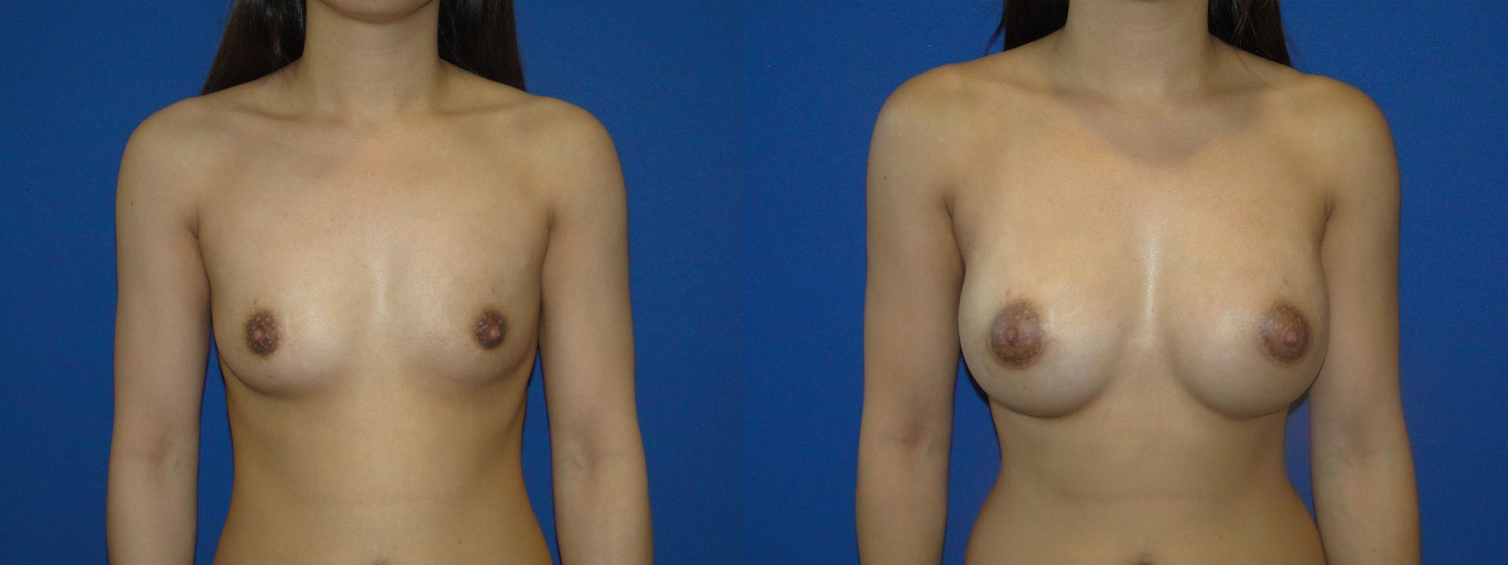 Breast Augmentation Before & After Gallery - Patient 74801798 - Image 1