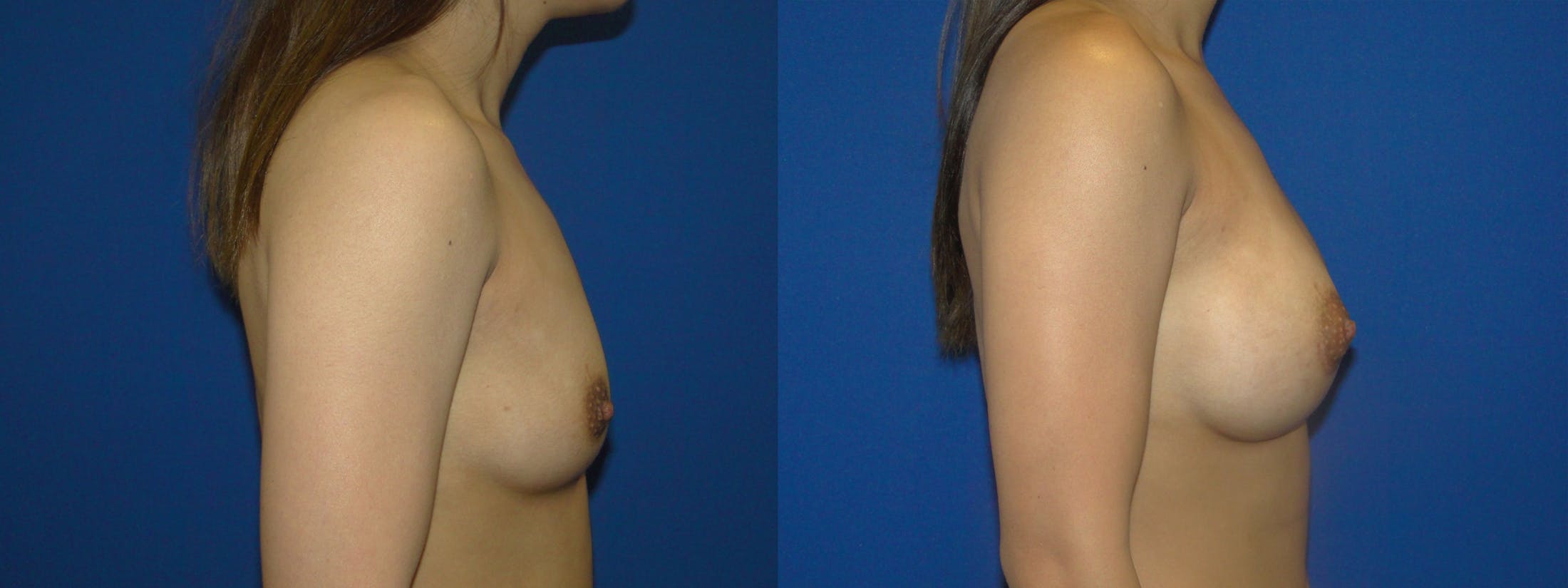 Breast Augmentation Gallery - Patient 74801798 - Image 2