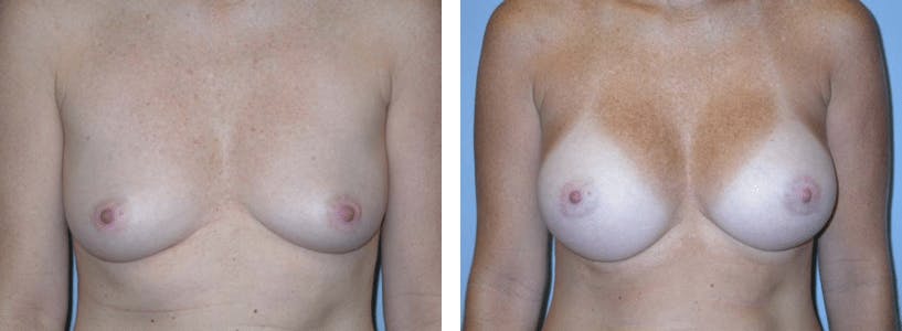 Breast Augmentation Before & After Gallery - Patient 74801799 - Image 1