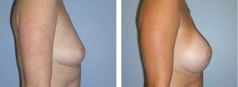 Breast Augmentation Before & After Gallery - Patient 74801799 - Image 2