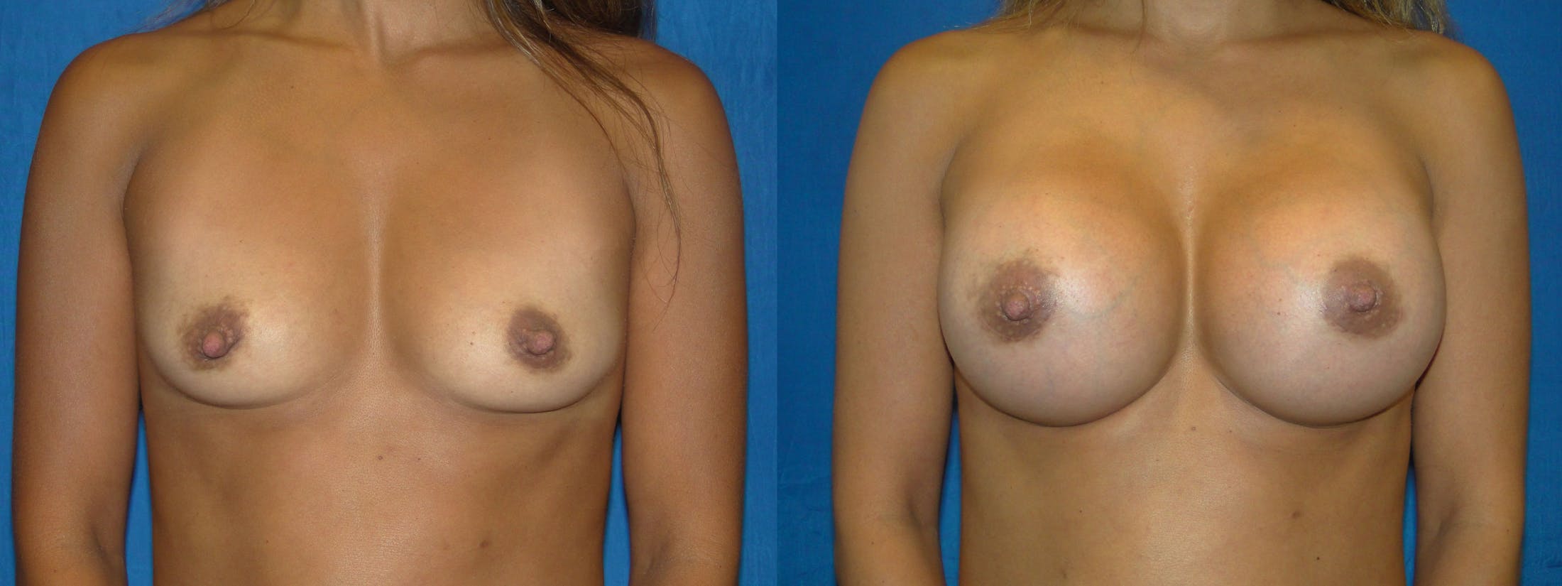 Breast Augmentation Before & After Gallery - Patient 74801800 - Image 1