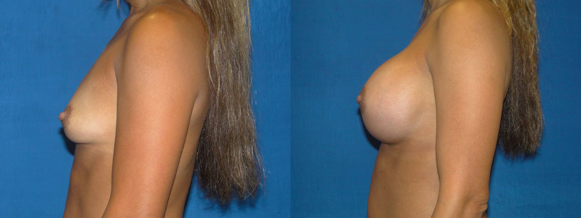 Breast Augmentation Before & After Gallery - Patient 74801800 - Image 2