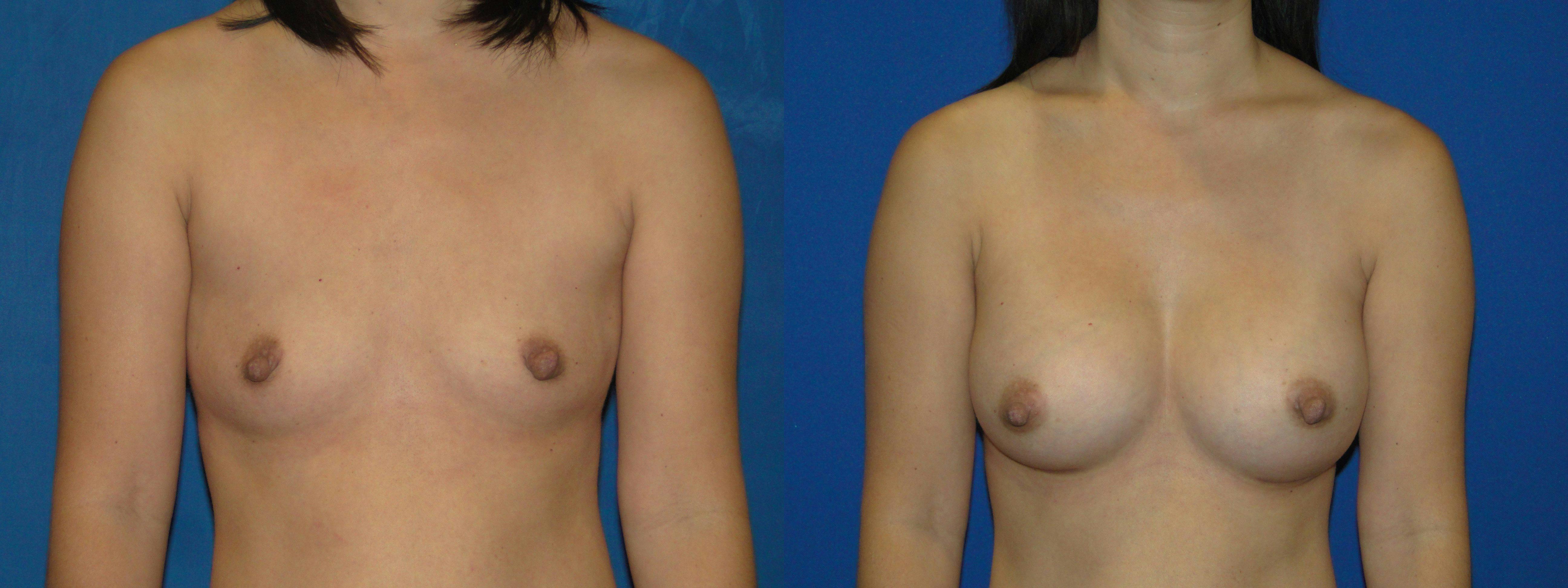 Before And After Breast Augmentation in Orange County - 05