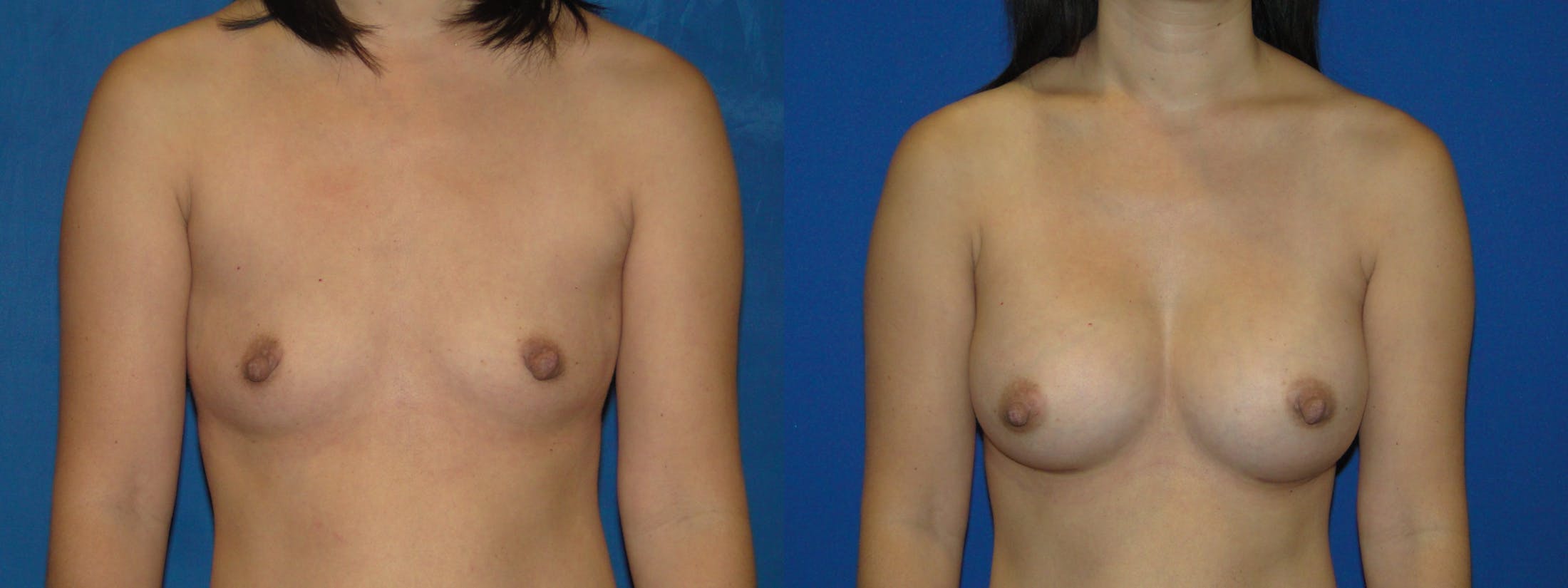 Breast Augmentation Before & After Gallery - Patient 74801803 - Image 1