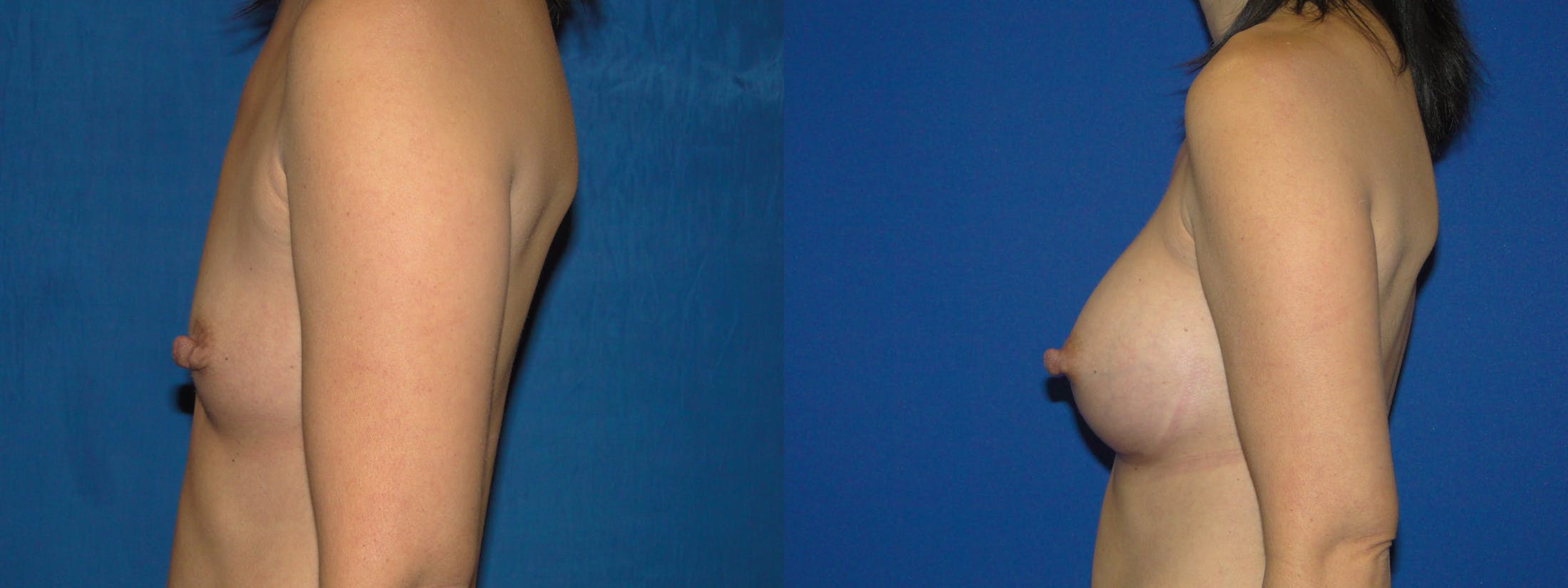 Breast Augmentation Before & After Gallery - Patient 74801803 - Image 2