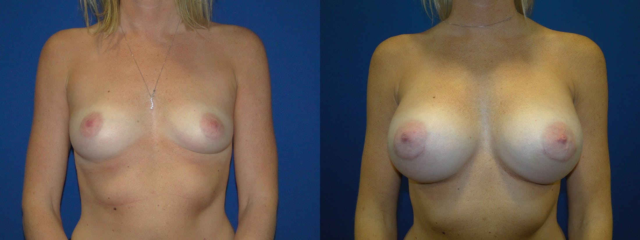Breast Augmentation Before & After Gallery - Patient 74801804 - Image 1