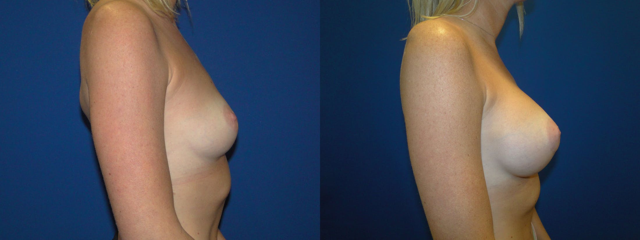 Breast Augmentation Before & After Gallery - Patient 74801804 - Image 2