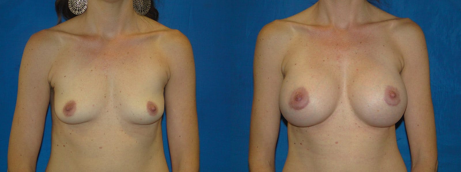 Breast Augmentation Before & After Gallery - Patient 74801805 - Image 1