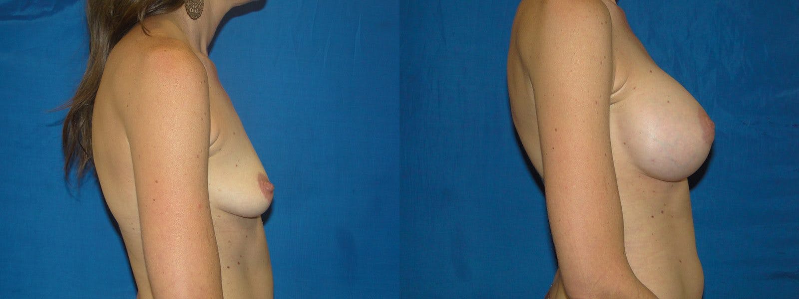 Breast Augmentation Before & After Gallery - Patient 74801805 - Image 2