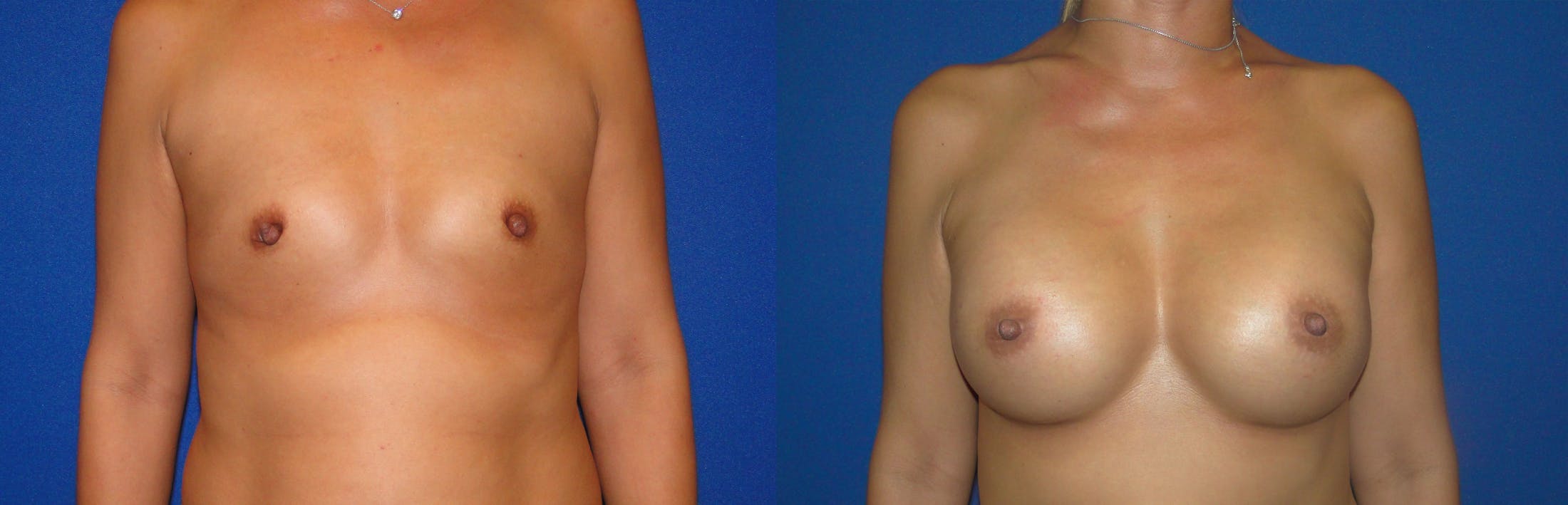Breast Augmentation Before & After Gallery - Patient 74801806 - Image 1