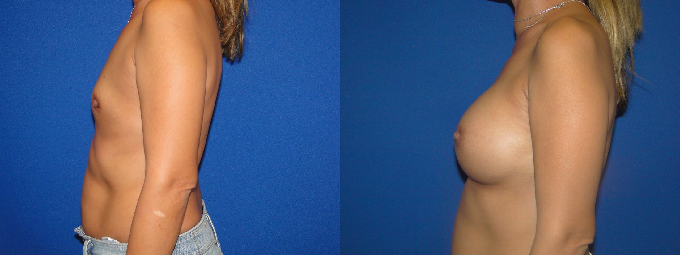Breast Augmentation Before & After Gallery - Patient 74801806 - Image 2