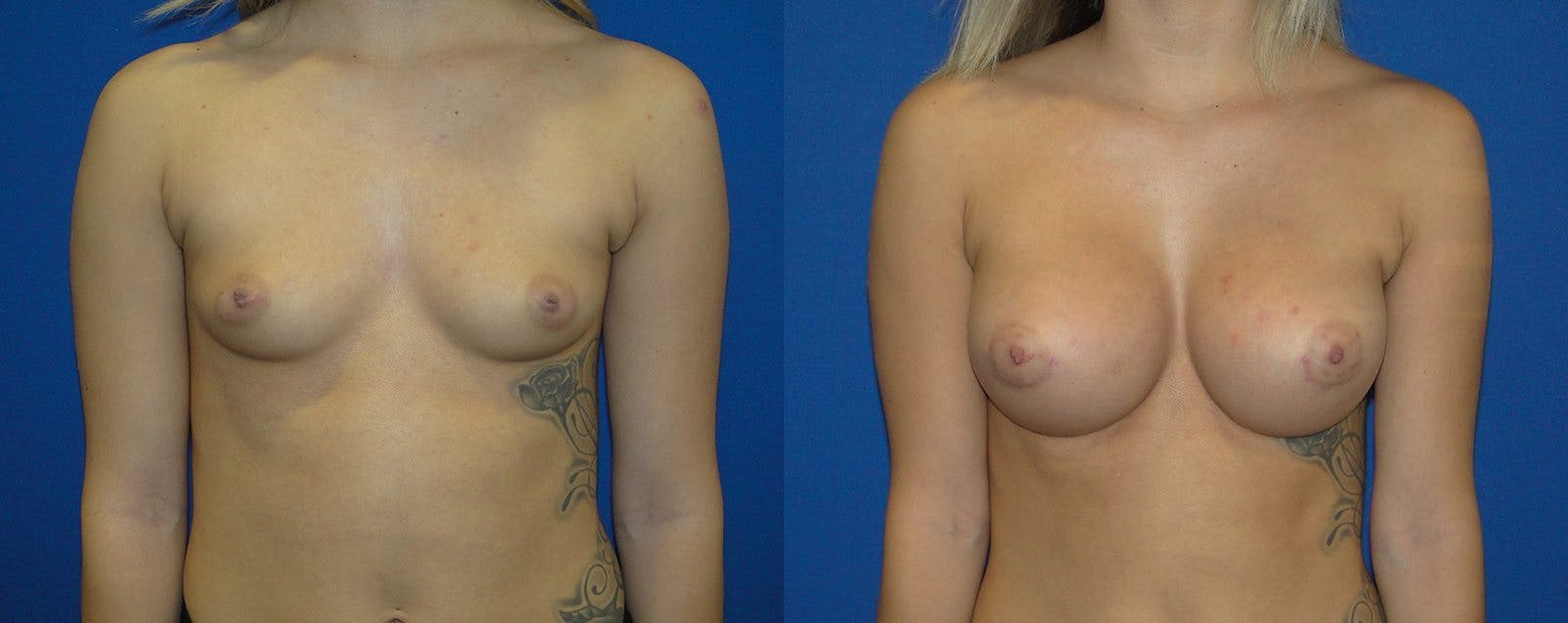 Breast Augmentation Before & After Gallery - Patient 74801807 - Image 1
