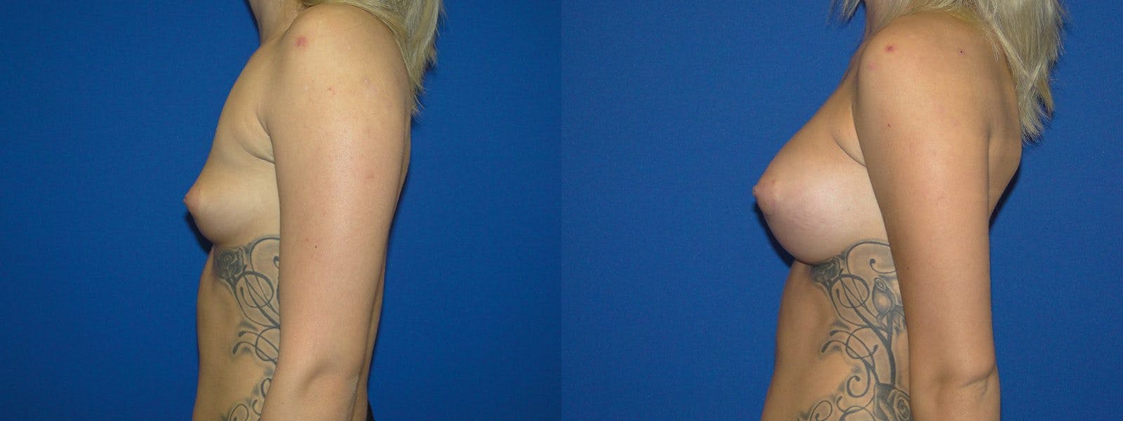 Breast Augmentation Before & After Gallery - Patient 74801807 - Image 2