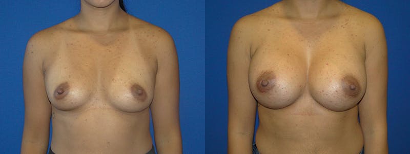 Breast Augmentation Before & After Gallery - Patient 74801808 - Image 1