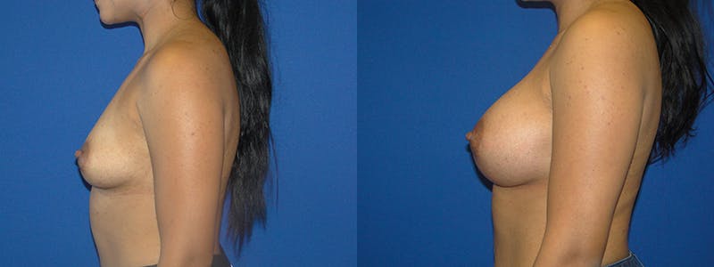 Breast Augmentation Before & After Gallery - Patient 74801808 - Image 2
