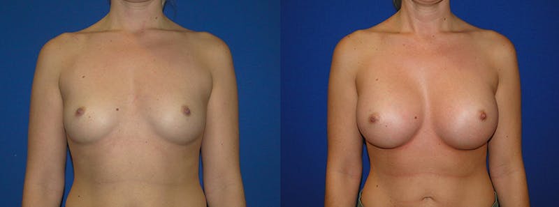 Breast Augmentation Before & After Gallery - Patient 74801809 - Image 1