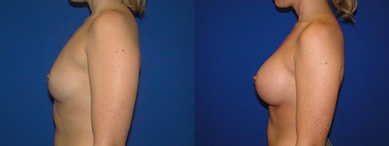 Breast Augmentation Before & After Gallery - Patient 74801809 - Image 2