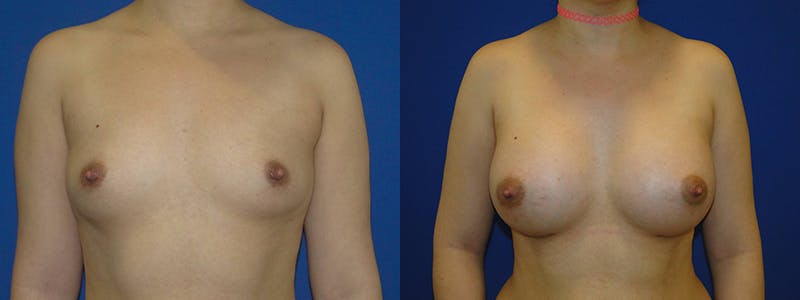 Breast Augmentation Before & After Gallery - Patient 74801810 - Image 1