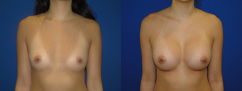 Breast Augmentation Before & After Gallery - Patient 74801811 - Image 1