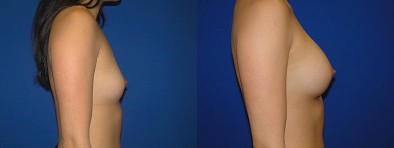 Breast Augmentation Before & After Gallery - Patient 74801811 - Image 2