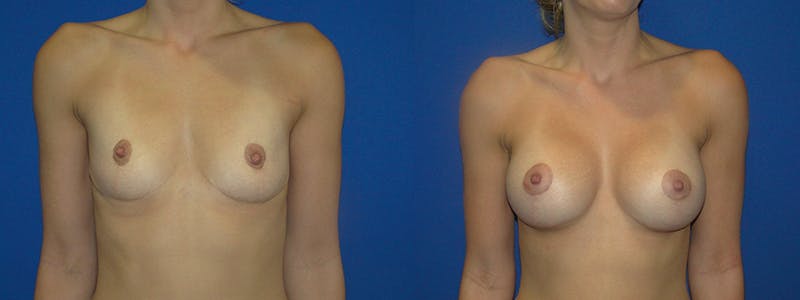 Breast Augmentation Before & After Gallery - Patient 74801812 - Image 1