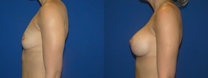 Breast Augmentation Before & After Gallery - Patient 74801812 - Image 2