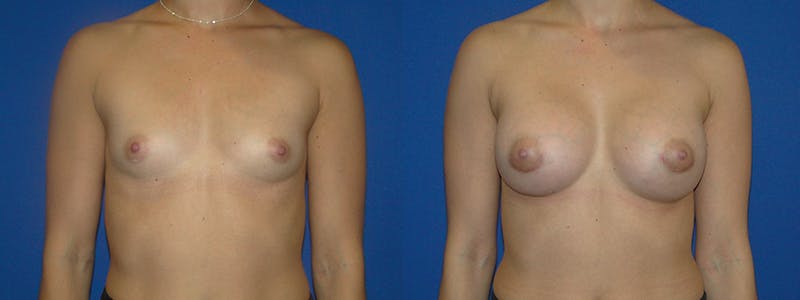 Breast Augmentation Before & After Gallery - Patient 74801813 - Image 1