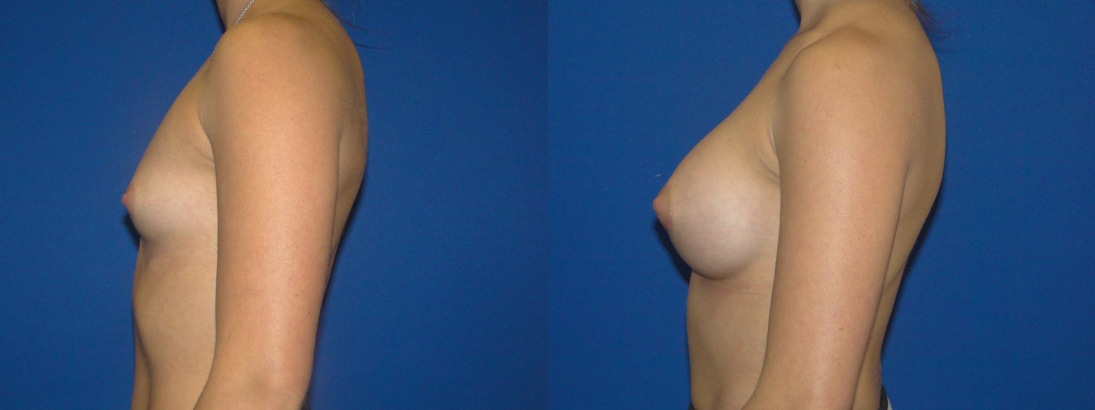 Breast Augmentation Gallery - Patient 74801813 - Image 2