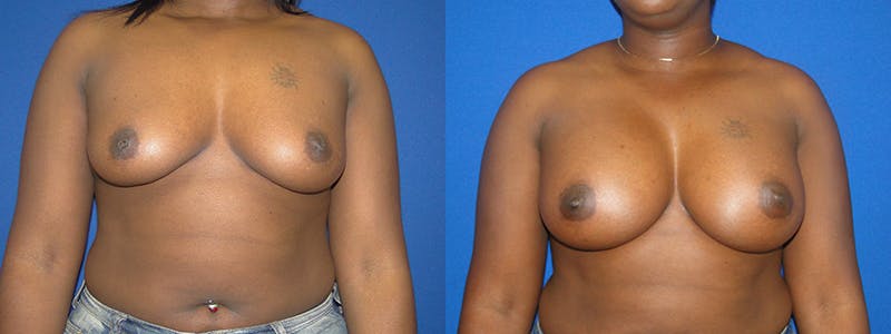 Breast Augmentation Gallery - Patient 74801815 - Image 1