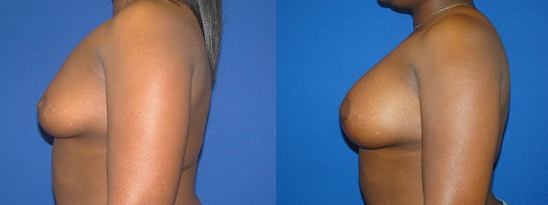 Breast Augmentation Before & After Gallery - Patient 74801815 - Image 2