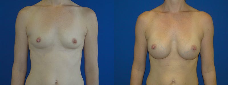 Breast Augmentation Before & After Gallery - Patient 74801816 - Image 1