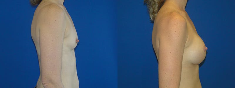 Breast Augmentation Before & After Gallery - Patient 74801816 - Image 2