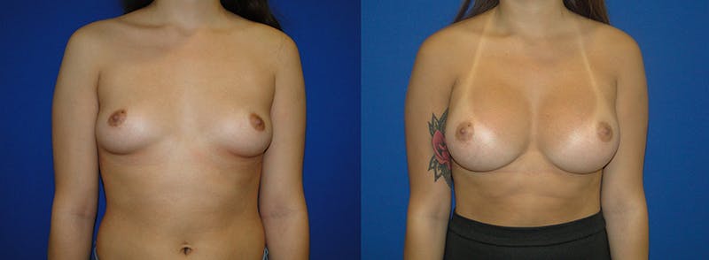 Breast Augmentation Before & After Gallery - Patient 74801817 - Image 1