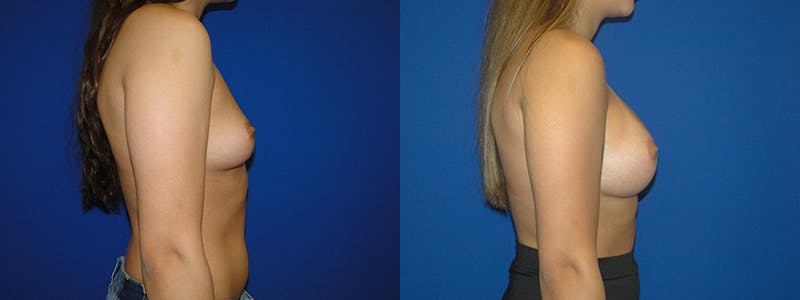 Breast Augmentation Before & After Gallery - Patient 74801817 - Image 2