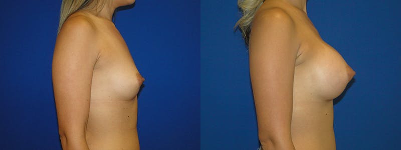 Breast Augmentation Before & After Gallery - Patient 74801818 - Image 2