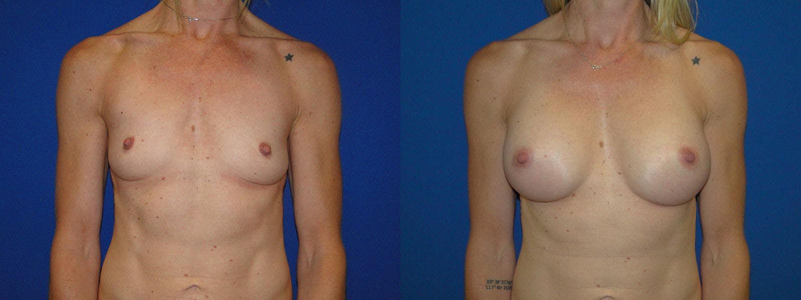 Breast Augmentation Before & After Gallery - Patient 74801819 - Image 1