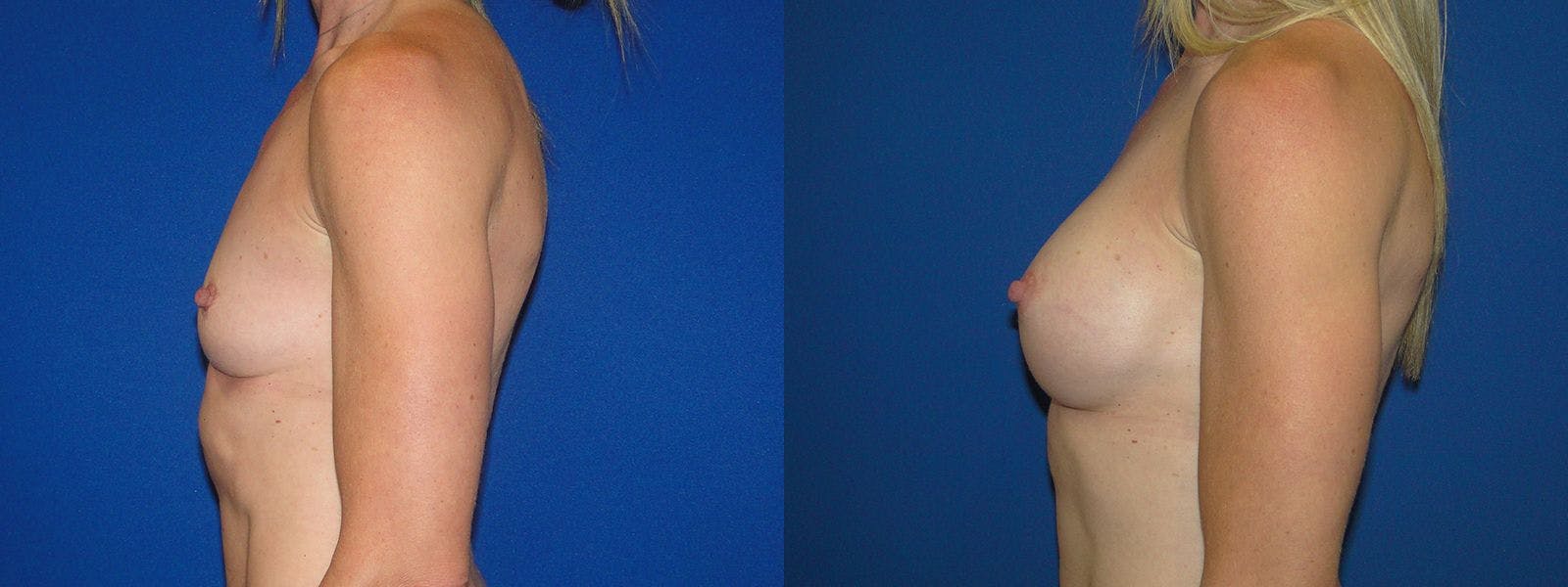 Breast Augmentation Before & After Gallery - Patient 74801819 - Image 2