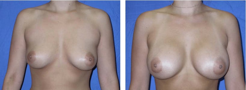 Breast Augmentation Before & After Gallery - Patient 74801822 - Image 1