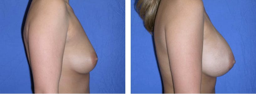 Breast Augmentation Before & After Gallery - Patient 74801822 - Image 2
