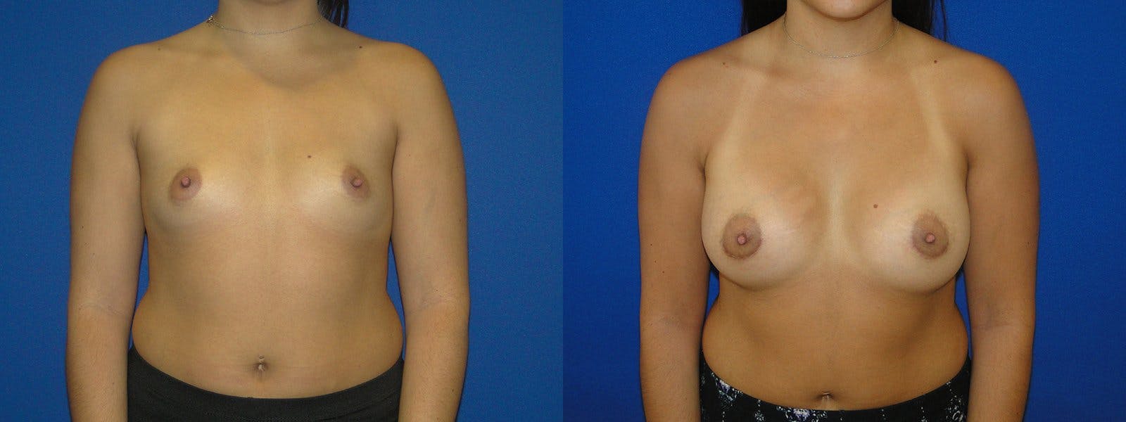 Breast Augmentation Before & After Gallery - Patient 74801824 - Image 1