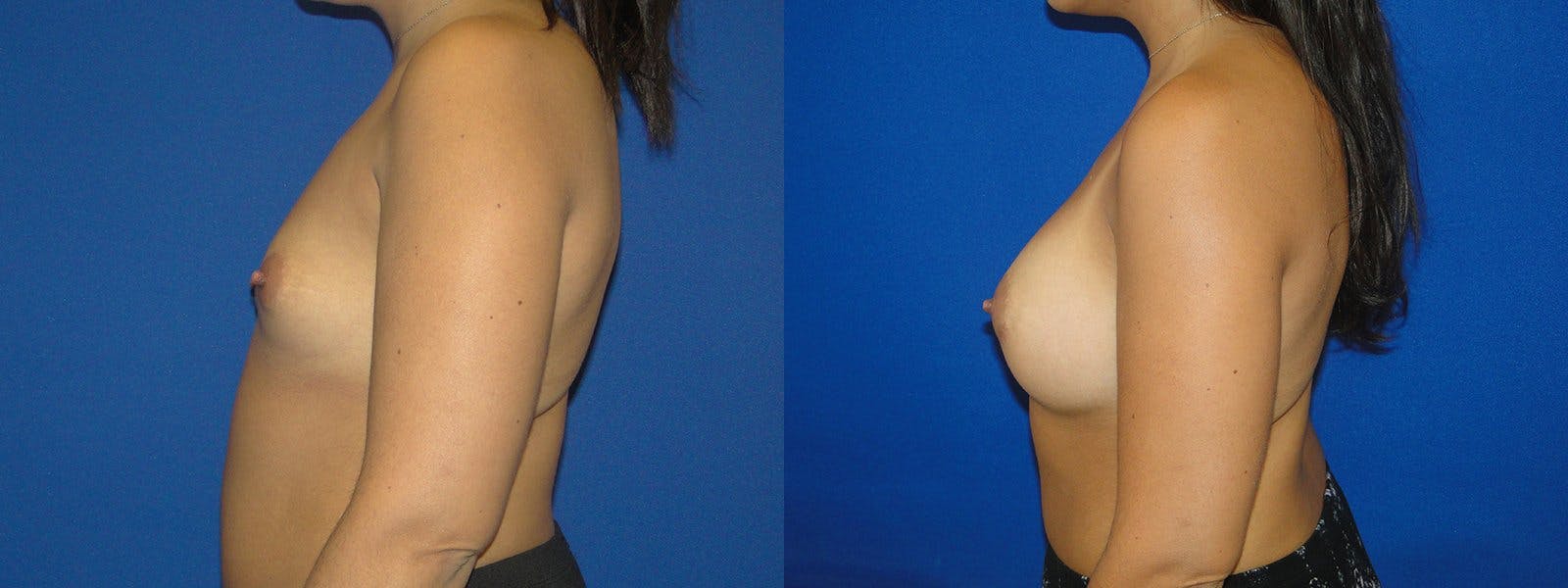 Breast Augmentation Before & After Gallery - Patient 74801824 - Image 2