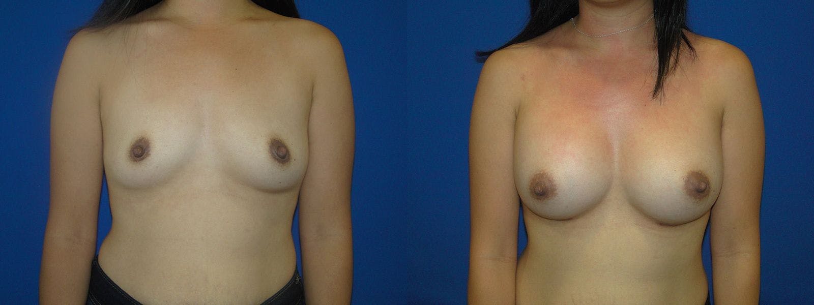Breast Augmentation Before & After Gallery - Patient 74801825 - Image 1