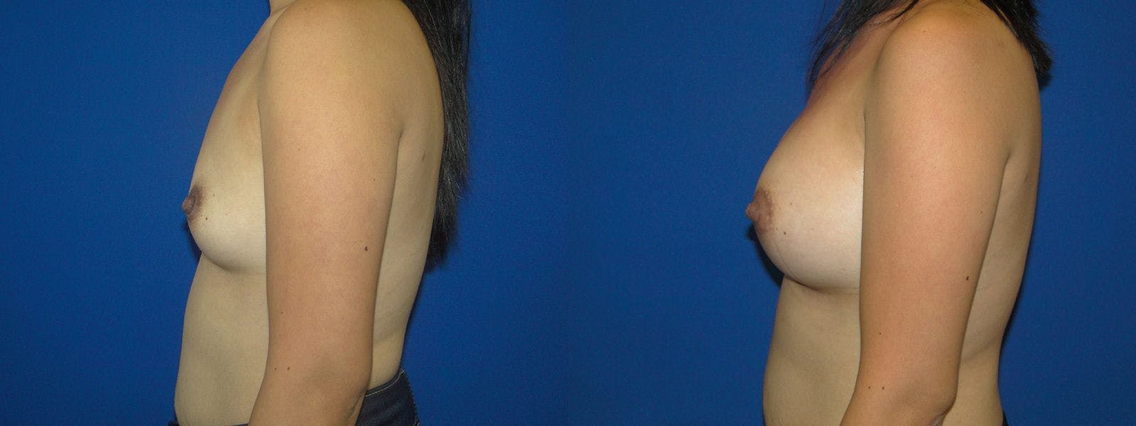 Breast Augmentation Before & After Gallery - Patient 74801825 - Image 2