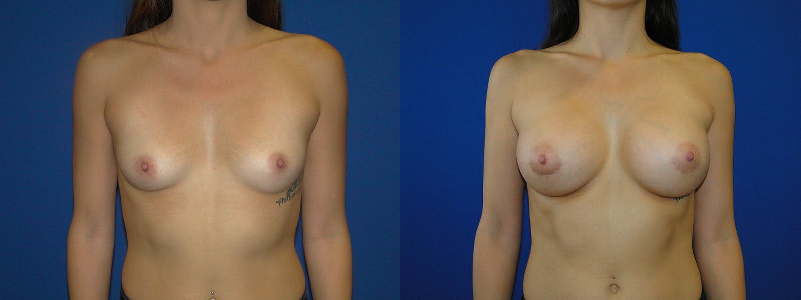 Breast Augmentation Before & After Gallery - Patient 74801826 - Image 1