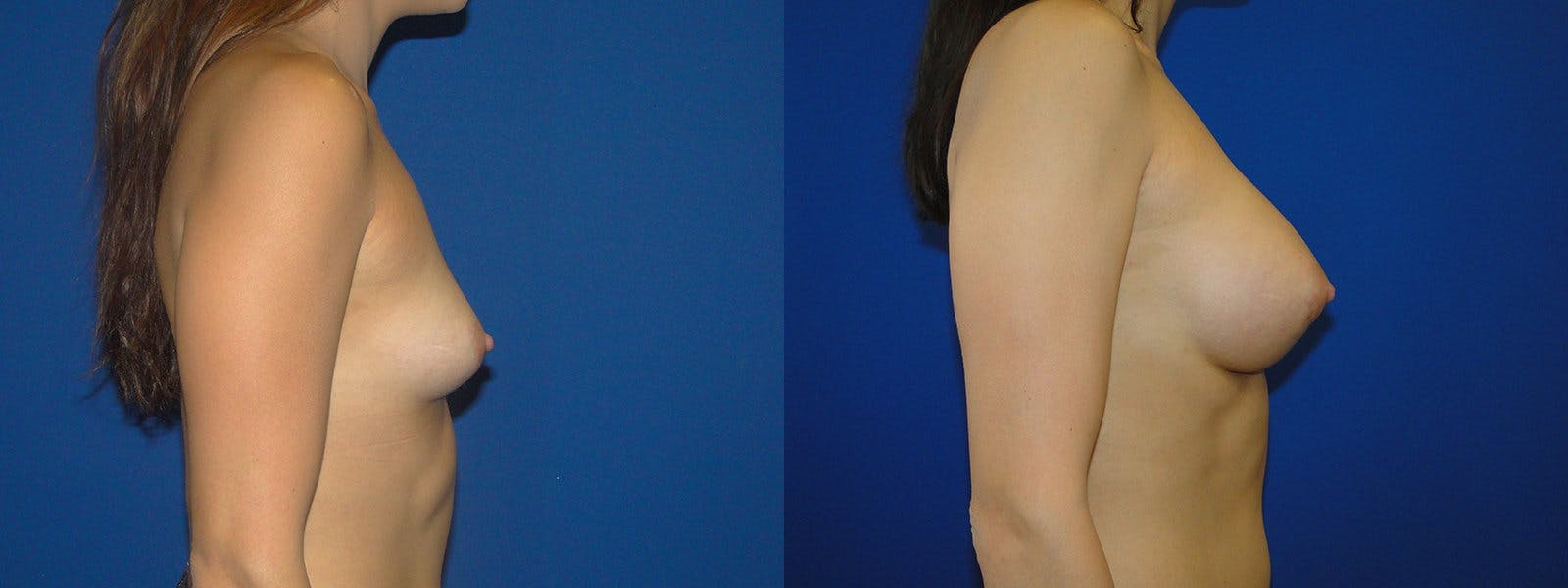 Breast Augmentation Before & After Gallery - Patient 74801826 - Image 2