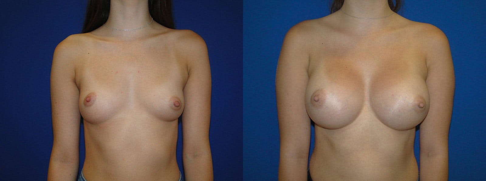 Breast Augmentation Before & After Gallery - Patient 74801827 - Image 1